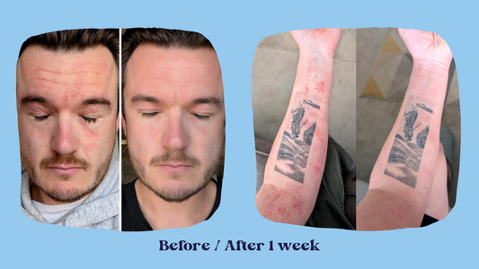 Eczema and Topical Steroid Withdrawal (TSW)